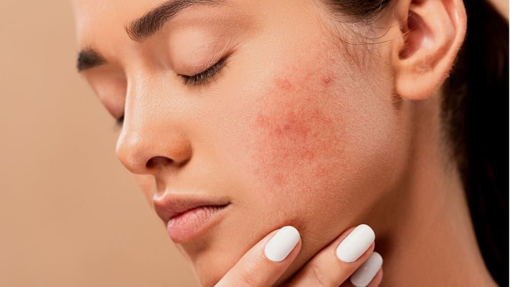 can-face-mapping-really-help-improve-your-skin-acne